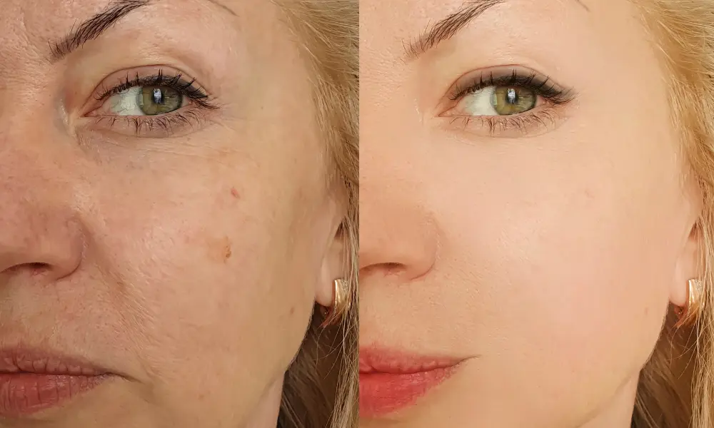 before after (1)