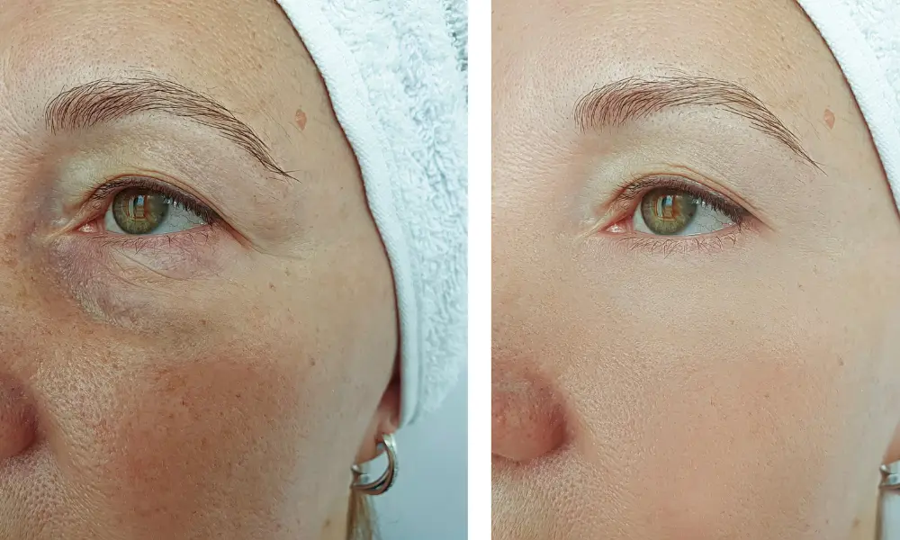 before after (2)
