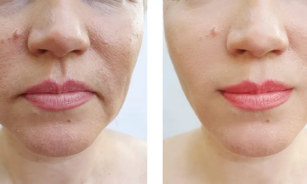 before after (4)